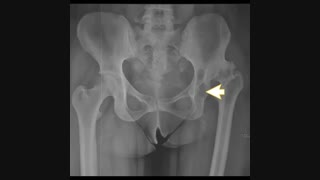 مثال هایی از جراحی تعویض مفصل ران در دررفتگی مادرزادی لگن