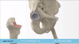 توتال هیپ چیست