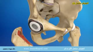 جراحی مفصل مصنوعی لگن چیست