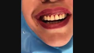 لیفت لثه و انجام کامپوزیت ونیر