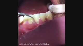 دندانپزشکی سعادت آباد، دکتر بالوی پور لیزر مو