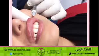 تزریق ژل لب