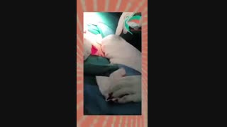 زایمان سزارین به علت دفع مکونیوم توسط جنین در شکم مادر