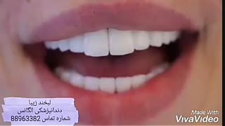 بهترین متخصص اصلاح  لبخند | طریقه اصلاح طرح لبخند | فیلم اصلاح طرح لبخند | لبخند هالیوودی