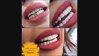 انواع ونیر کامپوزیت دندان | انواع روکش دندان | کامپوزیت دندان | فیلم ترمیم کامپوزیت دندان | قیمت نگین دندان