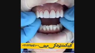 لمینت ونیر دندان چیست؟