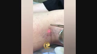 فیلم لیزر عروق واریسی