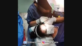 فیلم کاشت ابرو کلینیک آریامن