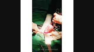 عمل هیسترکتومی