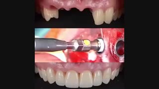 بازسازی دندان های از دست رفته