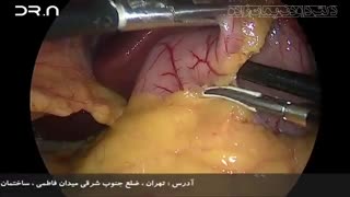 فیلم عمل جراحی لاپاراسکوپی اسلیو معده توسط دکتر داود نریمان زاده