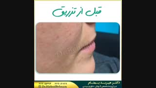 فیلم تزریق ژل لب هایفوتراپی