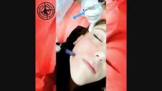 میکرونیدلینگ صورت