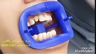 قیمت لمینیت سرامیکی سال 98 | عصب کشی دندان بدون درد |  فیلم عصب کشی دندان | فیلم جراحی دندان عقل