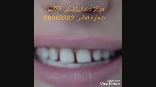 تفاوت ونیر کامپوزیت و لمینیت سرامیکی | بهترین مارک ایمپلنت دندان | انواع ایمپلنت دندان | مراحل ایمپلنت کردن دندان