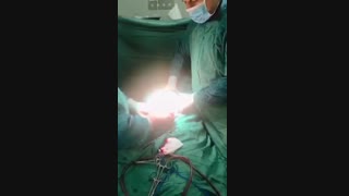 سزارین دوقلویی به روش آی وی اف