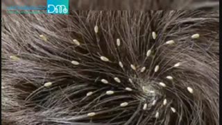 بهترین و سریع ترین روشهای درمان شپش موی سر