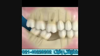 وقتی که جای خالی دندان به سایر دندان ها آسیب می رساند, جای خالی دندان با ایمپلنت می تواند پر شود