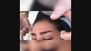 فیلم تزریق بوتاکس صورت