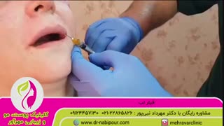فیلر لب