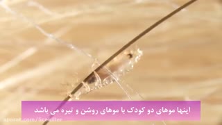 همه چیز درباره شپش سر