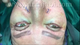 پایان عمل بلفاروپلاستی یا اصلاح پف پلک بالا و پایین