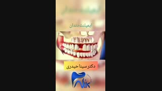 فیلم ایمپلنت دندان
