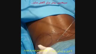 لیپوماتیک را با تیم حرفه ای تجربه کنید...