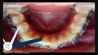 ارتودنسی تک فک در 9 جلسه