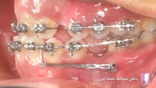 استفاده از TAD System | دکتر سیامک همت پور