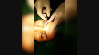 بلفاروپلاستی 09120303152