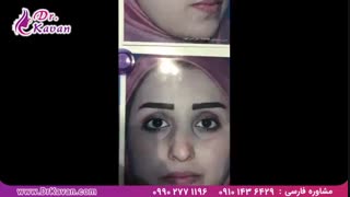 عمل زیبایی بینی