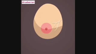 علائم سرطان سینه