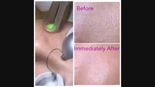 اجاره لیزر الکساندرایت کلاریتی