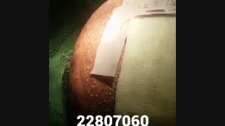 کاشت مو - دکتر ابدالی - 22807060