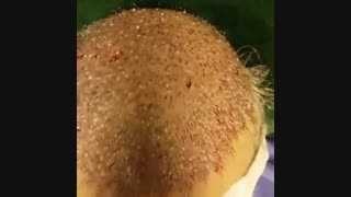 کاشت مو - دکتر ابدالی - 22807060