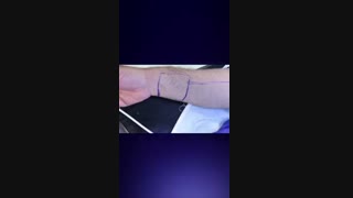 جراحی تومور پاروتید