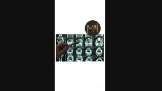 عود کردن تومور سینوس فکی