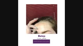 فیلم تزریق بوتاکس