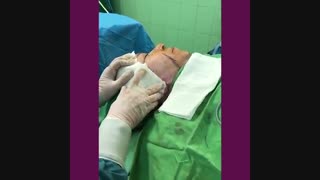 لیفت صورت بدون نیاز به بیهوشی تنها در یک جلسه